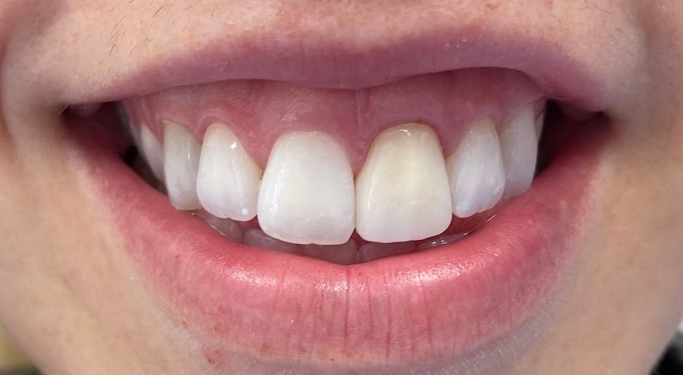 A close up of a person 's mouth with white teeth.