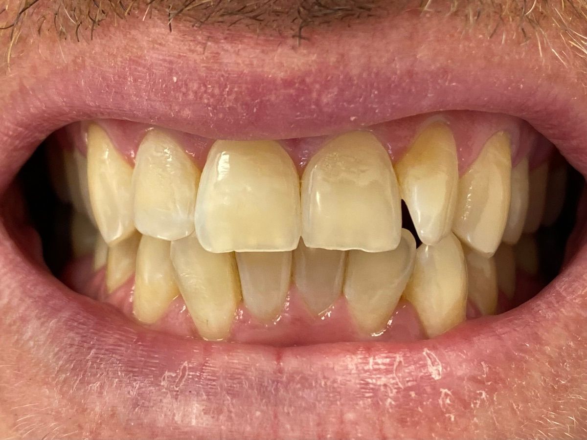A close up of a man 's teeth with a broken tooth.