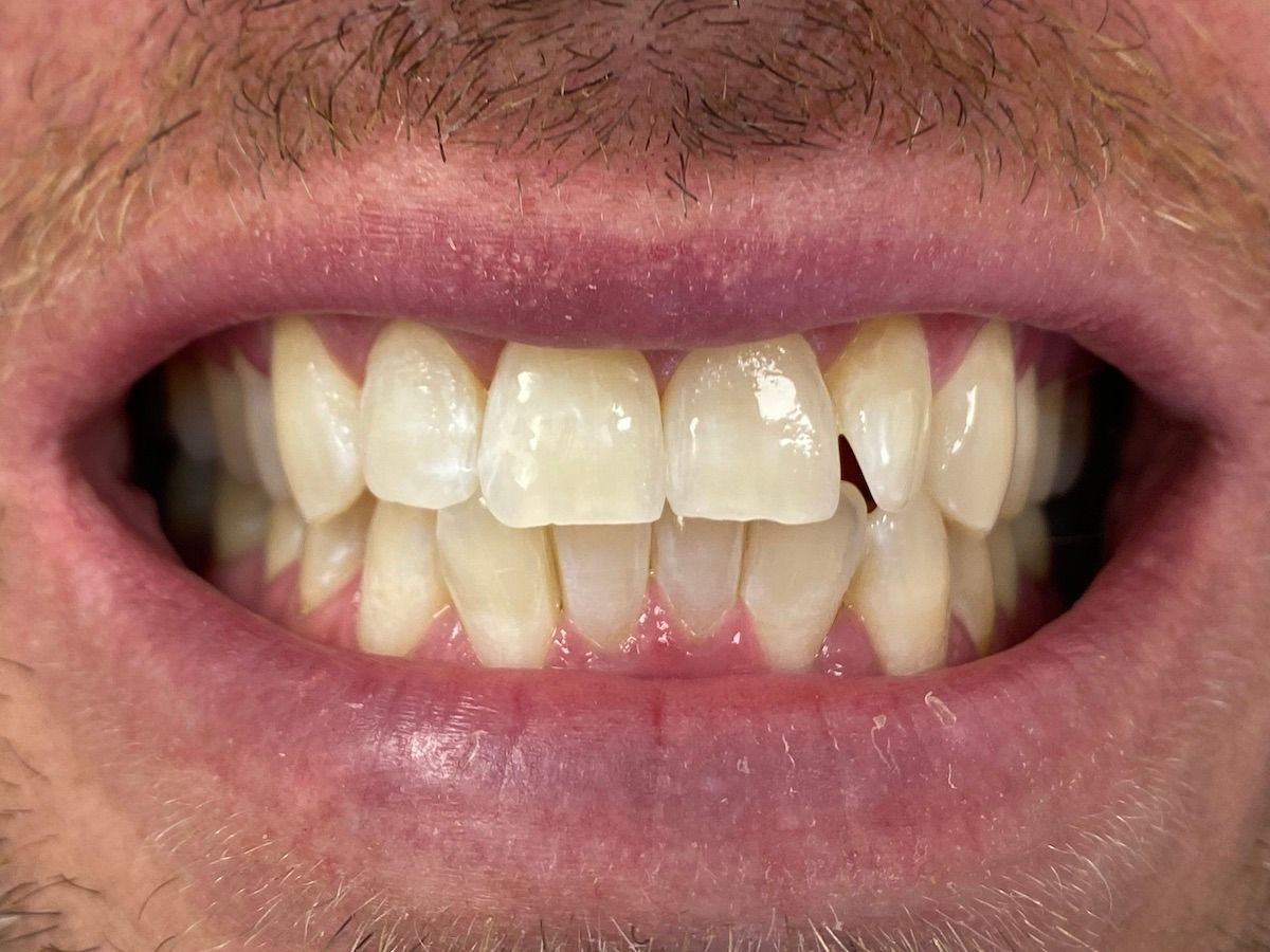 A close up of a man 's mouth with a broken tooth.