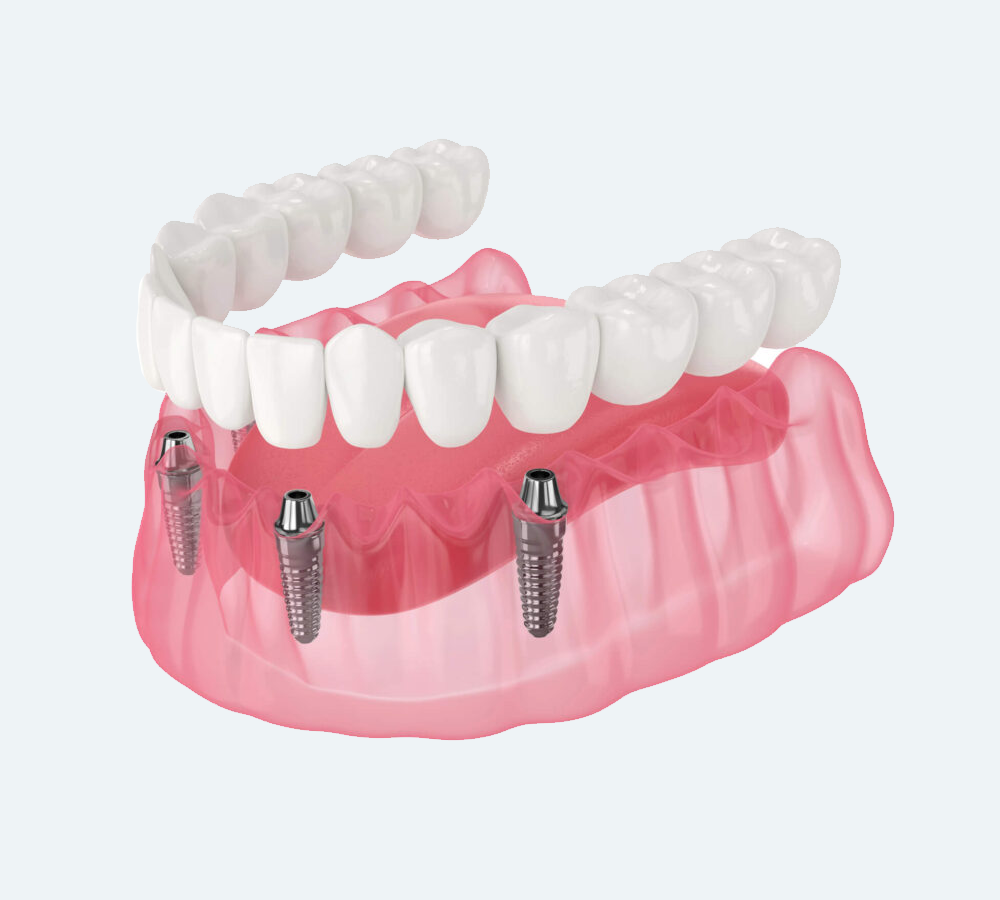 A digital illustration of a dental implant bridge with four metallic implants supporting a full arch of teeth.