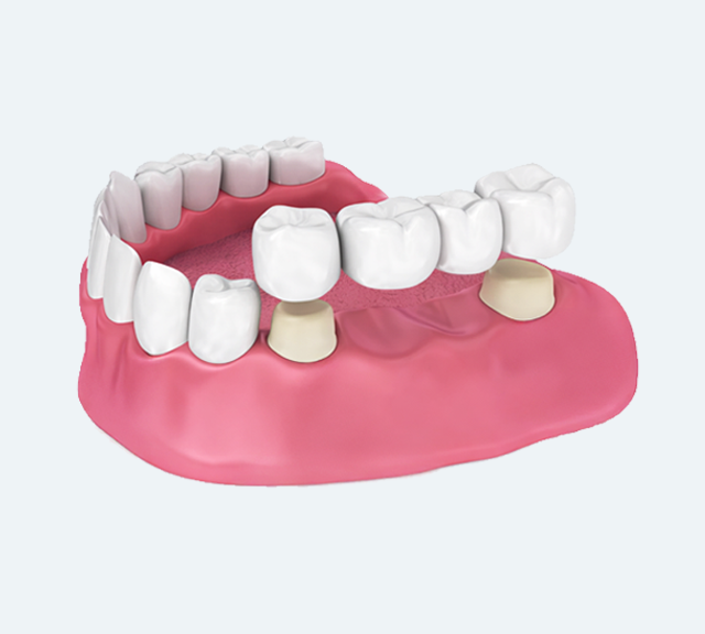 A dental crown being placed over a prepared tooth in a human jaw.