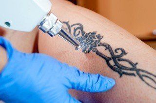 syneron candela tattoo removal
