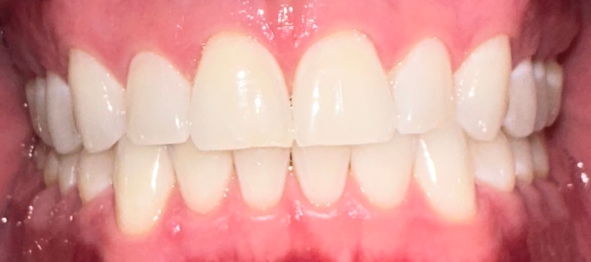 a close-up of a person's teeth with perfect straight white teeth.