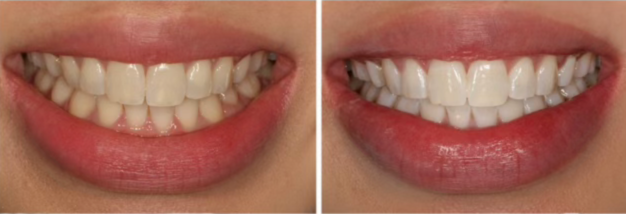 a before and after picture of a woman 's teeth .