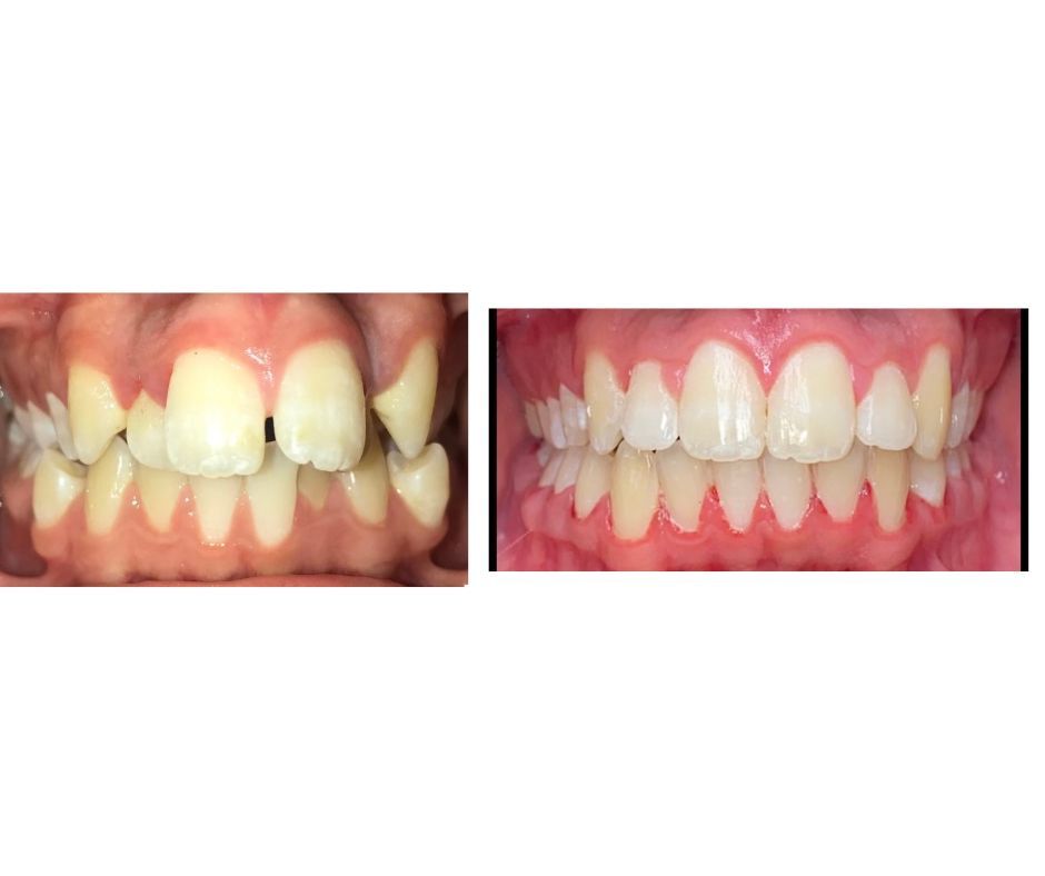 a before and after picture of a person 's teeth .