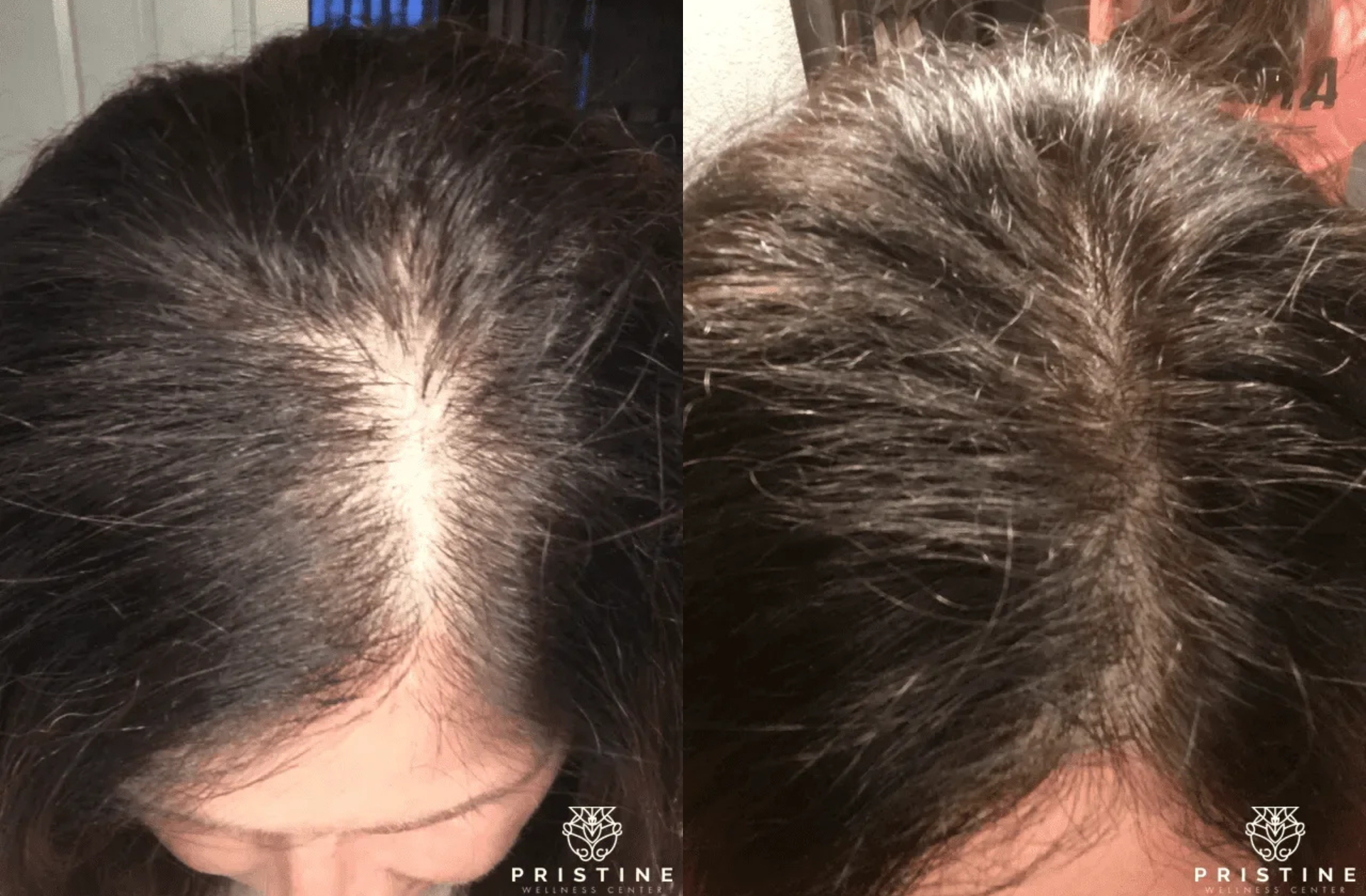 real patients before and after hair restoration treatment in san ramon, ca at pristine wellness center - Dr. Homeira Izadi