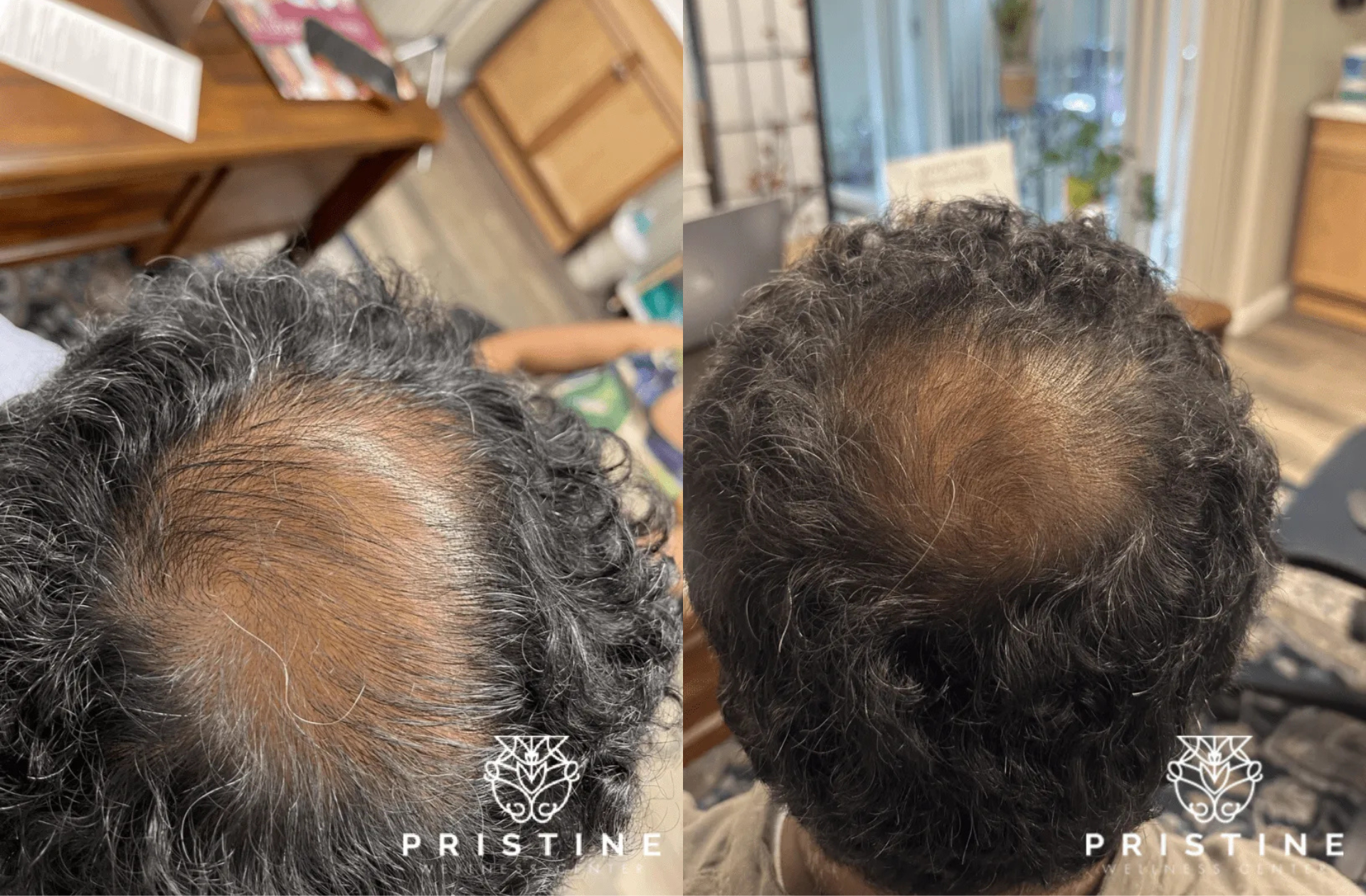real patients before and after hair restoration treatment in san ramon, ca at pristine wellness center - Dr. Homeira Izadi