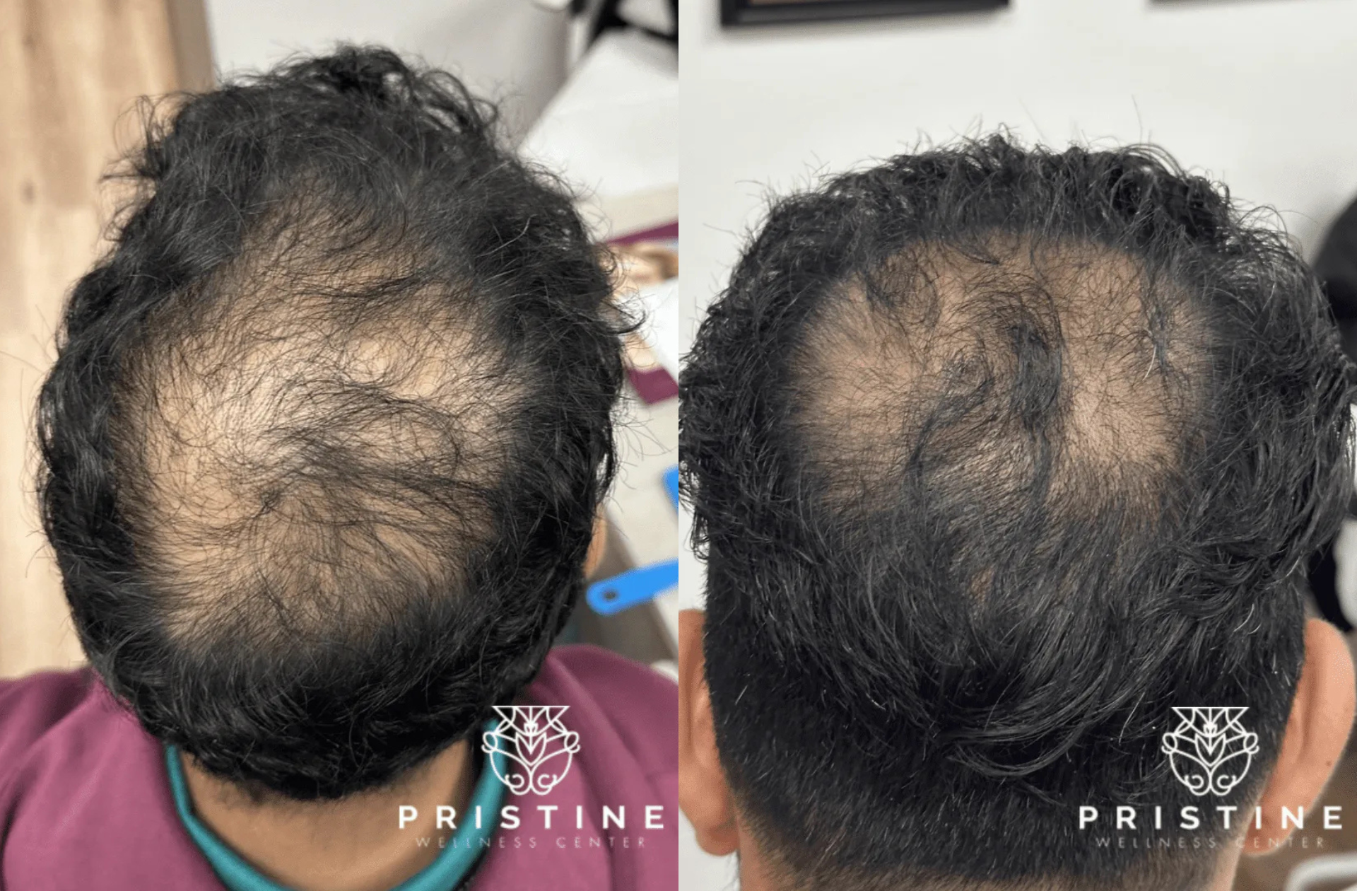 real patients before and after hair restoration treatment in san ramon, ca at pristine wellness center - Dr. Homeira Izadi