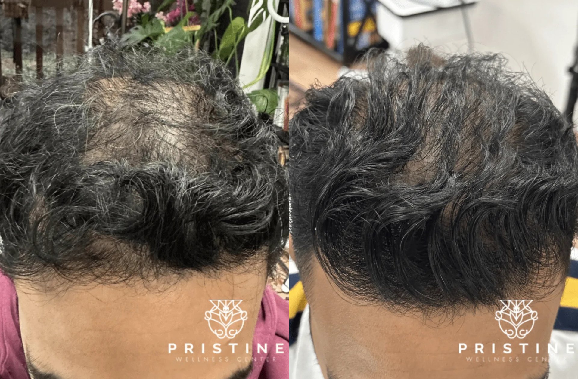 real patients before and after hair restoration treatment in san ramon, ca at pristine wellness center - Dr. Homeira Izadi