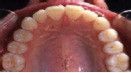 A close up of a person 's teeth and mouth.