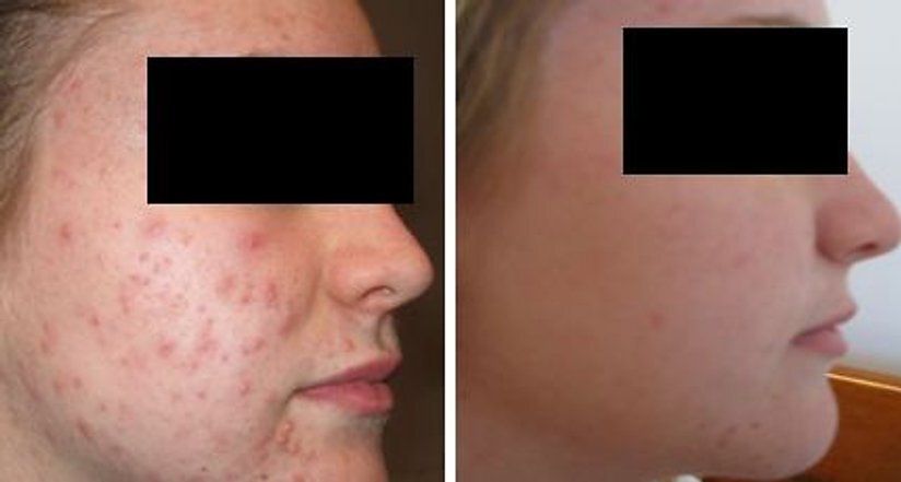 Before and After of Image of an Acne Woman Skin Closeup — Canberra, Act — Healthy Skin Solutions