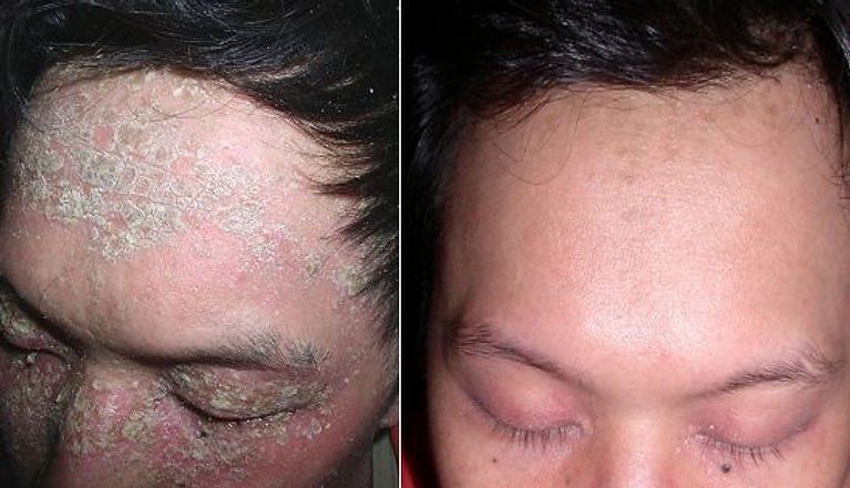 Before and After Image of a Psoriasis on Face — Canberra, Act — Healthy Skin Solutions