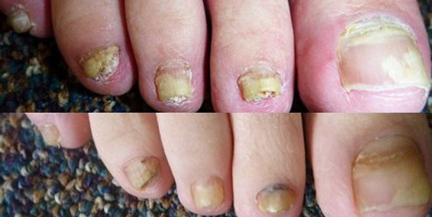 Close-Up Image of Nail Fungus — Canberra, Act — Healthy Skin Solutions