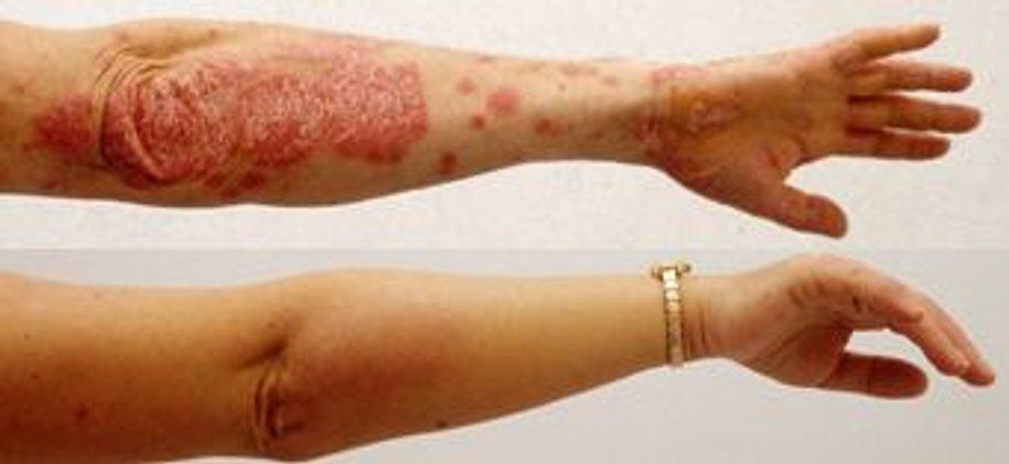 Before and After Image of Infected Psoriasis on the Hand — Canberra, Act — Healthy Skin Solutions