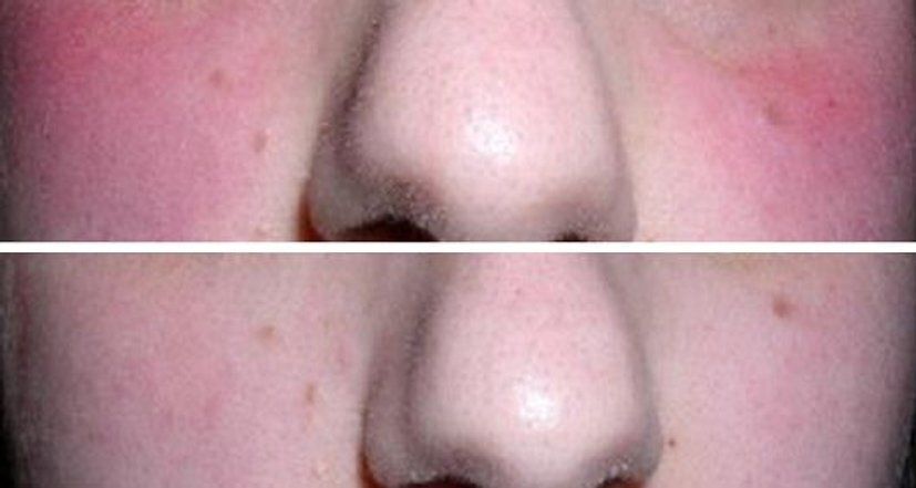Before and After of Image of Papulopustular Rosacea, Close-Up of the Patient's Cheek — Canberra, Act — Healthy Skin Solutions