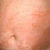 Image of a Body with Hives That Look Like a Rash — Canberra, Act — Healthy Skin Solutions