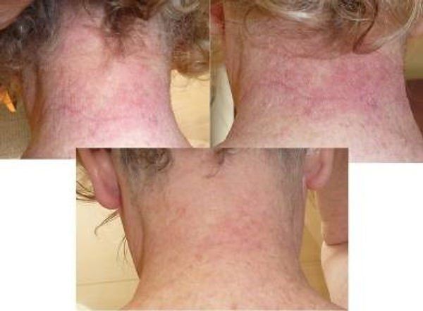Allergic Skin Reaction on the Female Neck — Canberra, Act — Healthy Skin Solutions