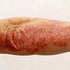 Image of an Arm with a Non-Infectious Skin Condition Psoriasis — Canberra, Act — Healthy Skin Solutions