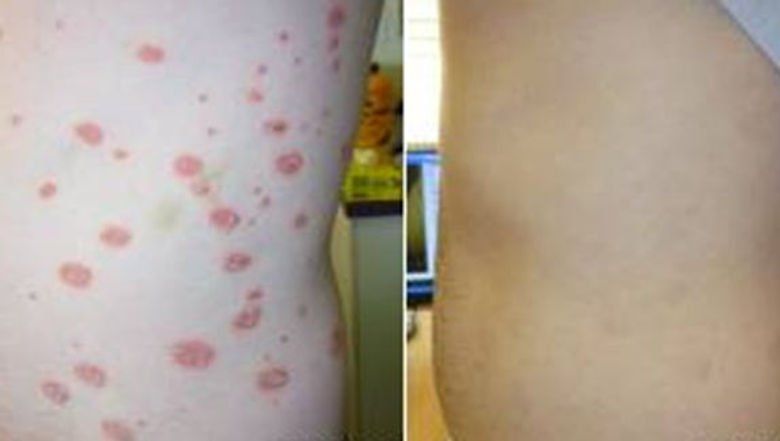 Before and After Skin Rash on Body — Canberra, Act — Healthy Skin Solutions
