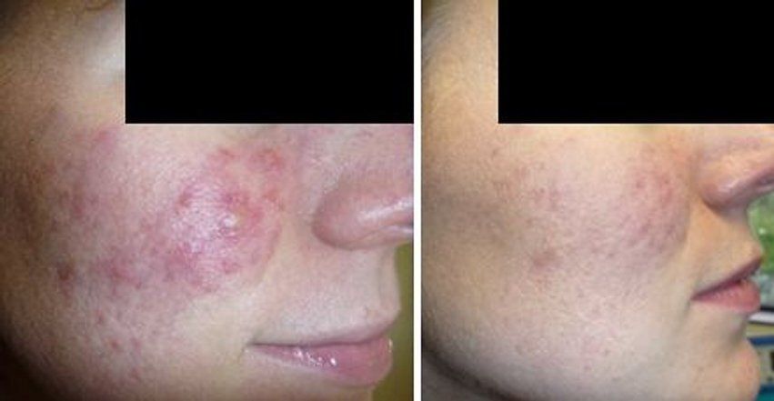 Before and After Face with Acne and Pimples Close-Up — Canberra, Act — Healthy Skin Solutions