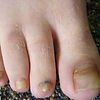 Image of Feet That Have a Bacterial Infection — Canberra, Act — Healthy Skin Solutions