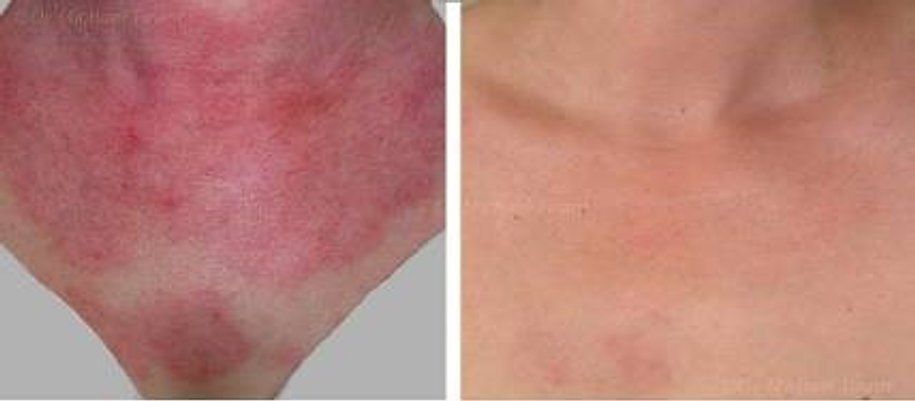 Before and After Image of a Strong Allergic Skin Reaction on the Female Neck — Canberra, Act — Healthy Skin Solutions