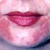 Image of a Face with Many Red Spots — Canberra, Act — Healthy Skin Solutions