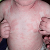 Image of a Body of a Child Have an Eczema — Canberra, Act — Healthy Skin Solutions