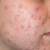 Image of a Face with a Very Common Skin Condition They Called Acne — Canberra, Act — Healthy Skin Solutions