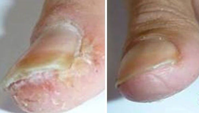 Close-Up Image of a Before and After Infected Finger — Canberra, Act — Healthy Skin Solutions