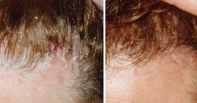 Psoriasis on the Hairline and on the Scalp-Close Up — Canberra, Act — Healthy Skin Solutions