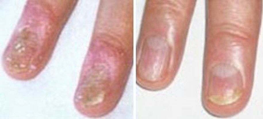 Before and After of an Infected Finger — Canberra, Act — Healthy Skin Solutions