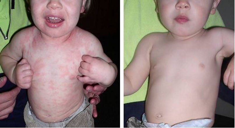 Body of a Child with Psoriasis Before and After — Canberra, Act — Healthy Skin Solutions