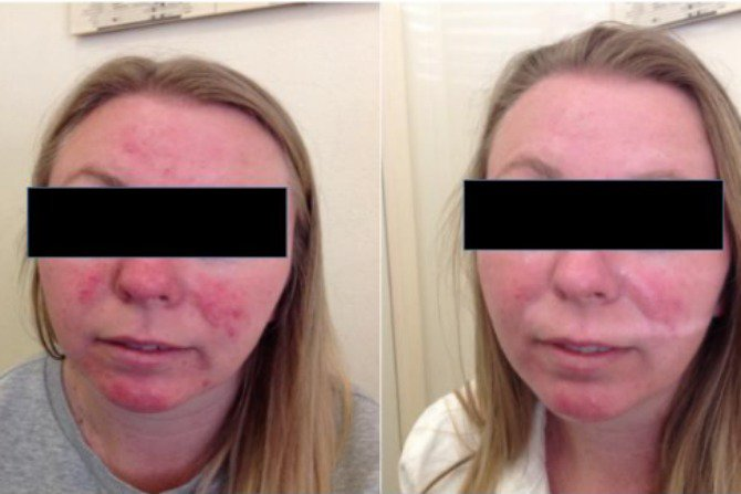 Skin Condition Rosacea Characterized by Facial Redness — Canberra, Act — Healthy Skin Solutions