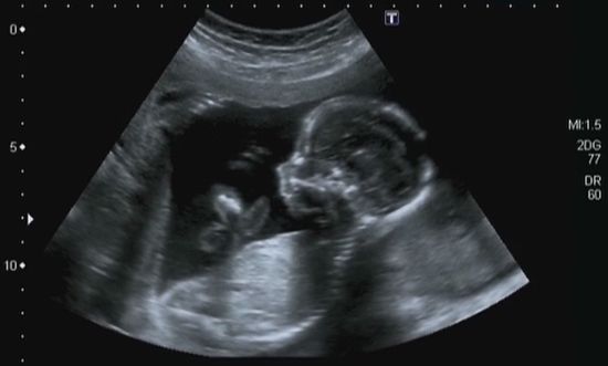 Screening prenatale
