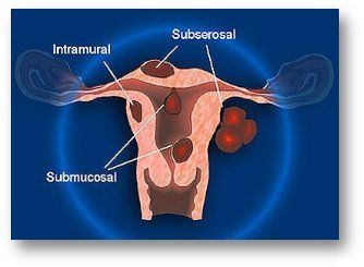 Fibroma uterino