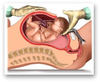 Intervento di cesareo