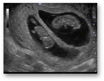 Gravidanza con gemelli