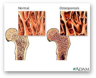Osteoporosi