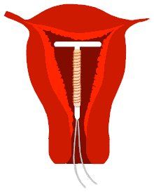 IUD