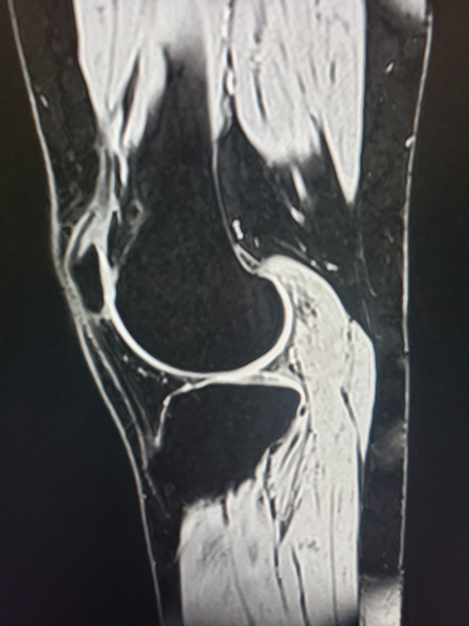 Knee MRI — Fairburn, GA — Imaging Diversified