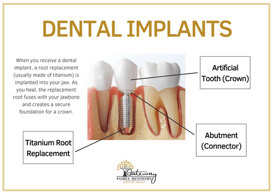 Dental Implants Graphic with Illustration