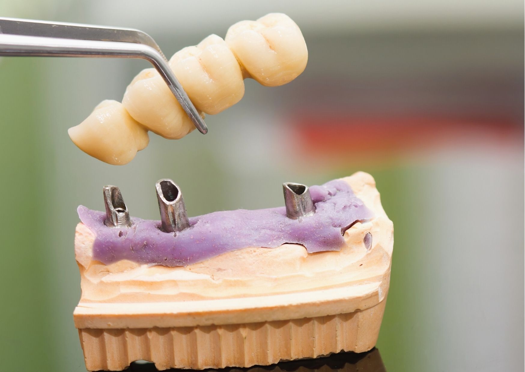 Implant Supported Dental Bridge