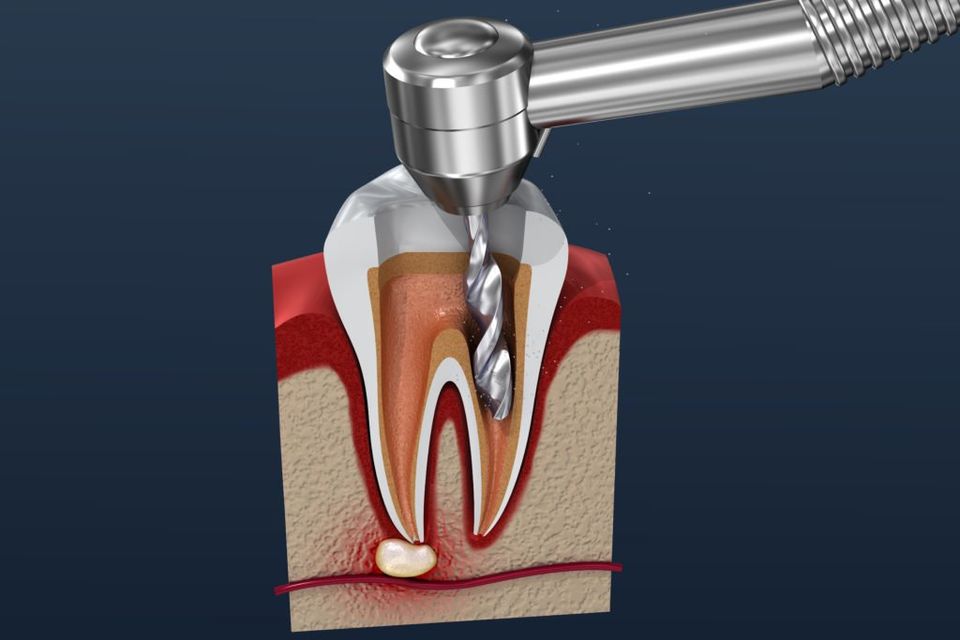 Root Canal Procedure Illustration