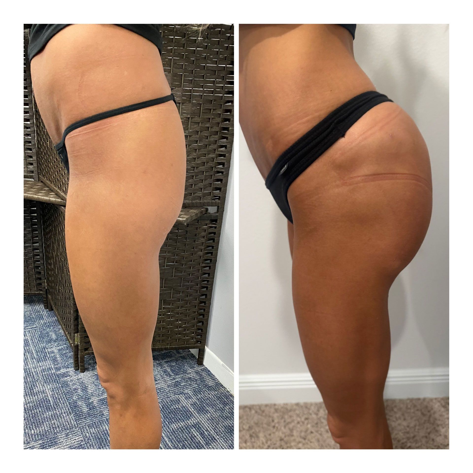 BBL Before and After 5