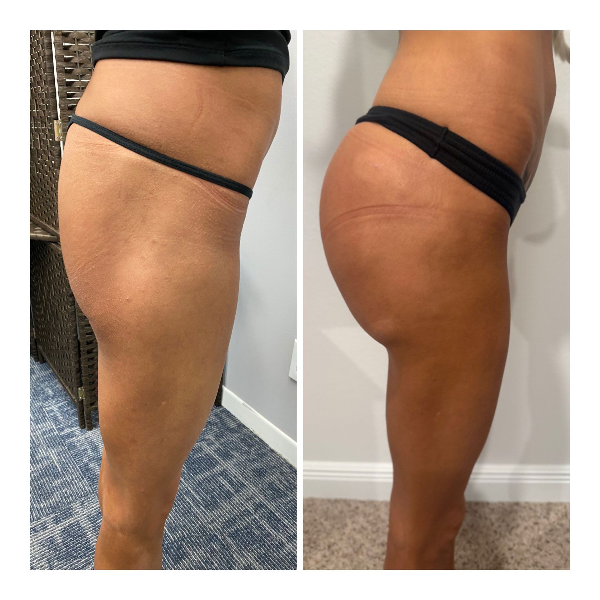 BBL Before and After 6