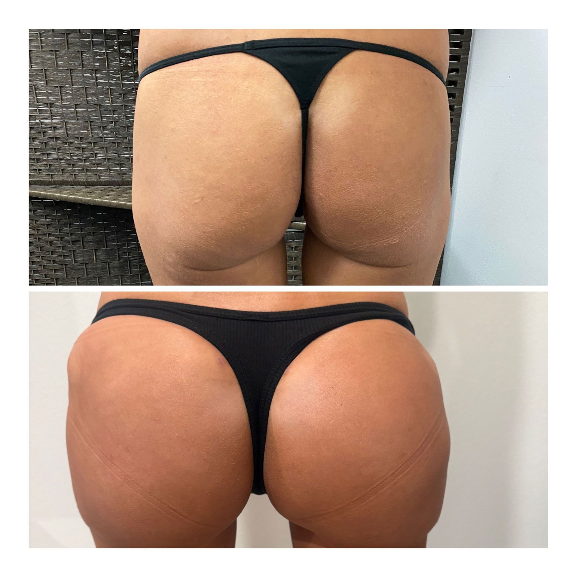 BBL Before and After 7