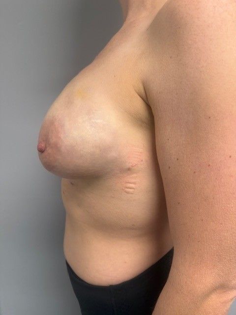 Non-surgical breast augmentation after 2