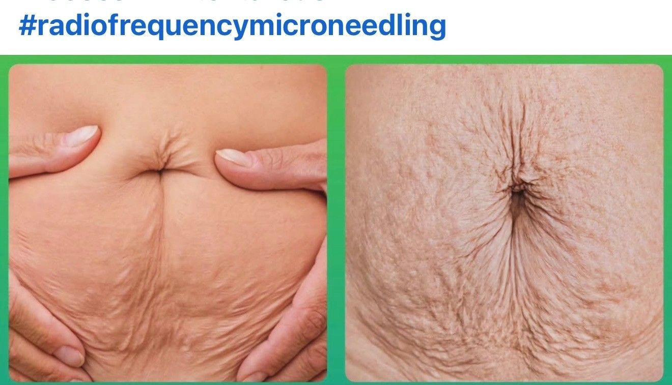 Radio Frequency Microneedling