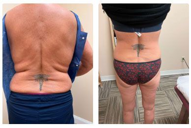 Emsculpt NEO Before & After 1